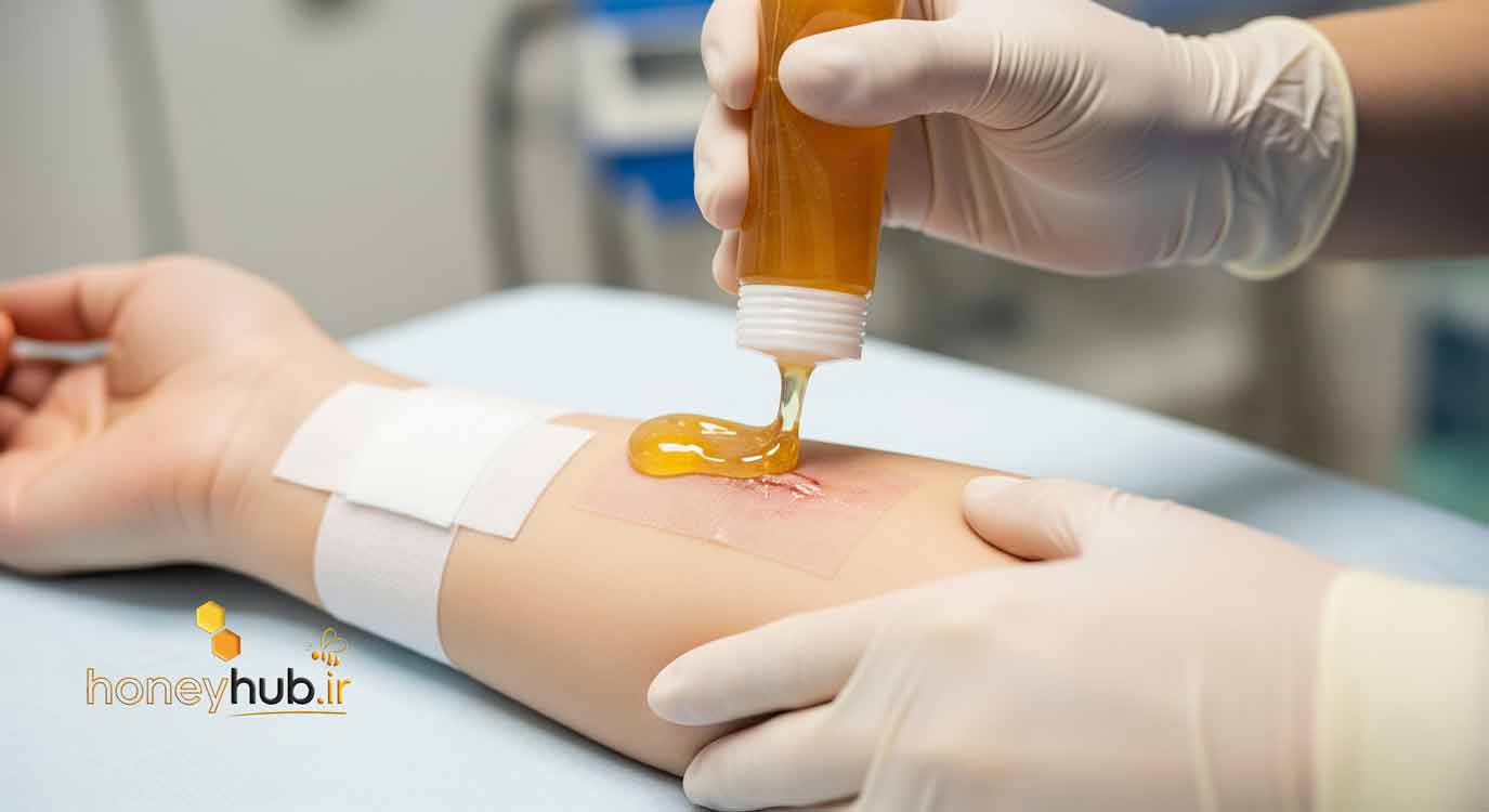 Medical-grade honey for wound treatment – Illustrative image of honey being applied to a wound